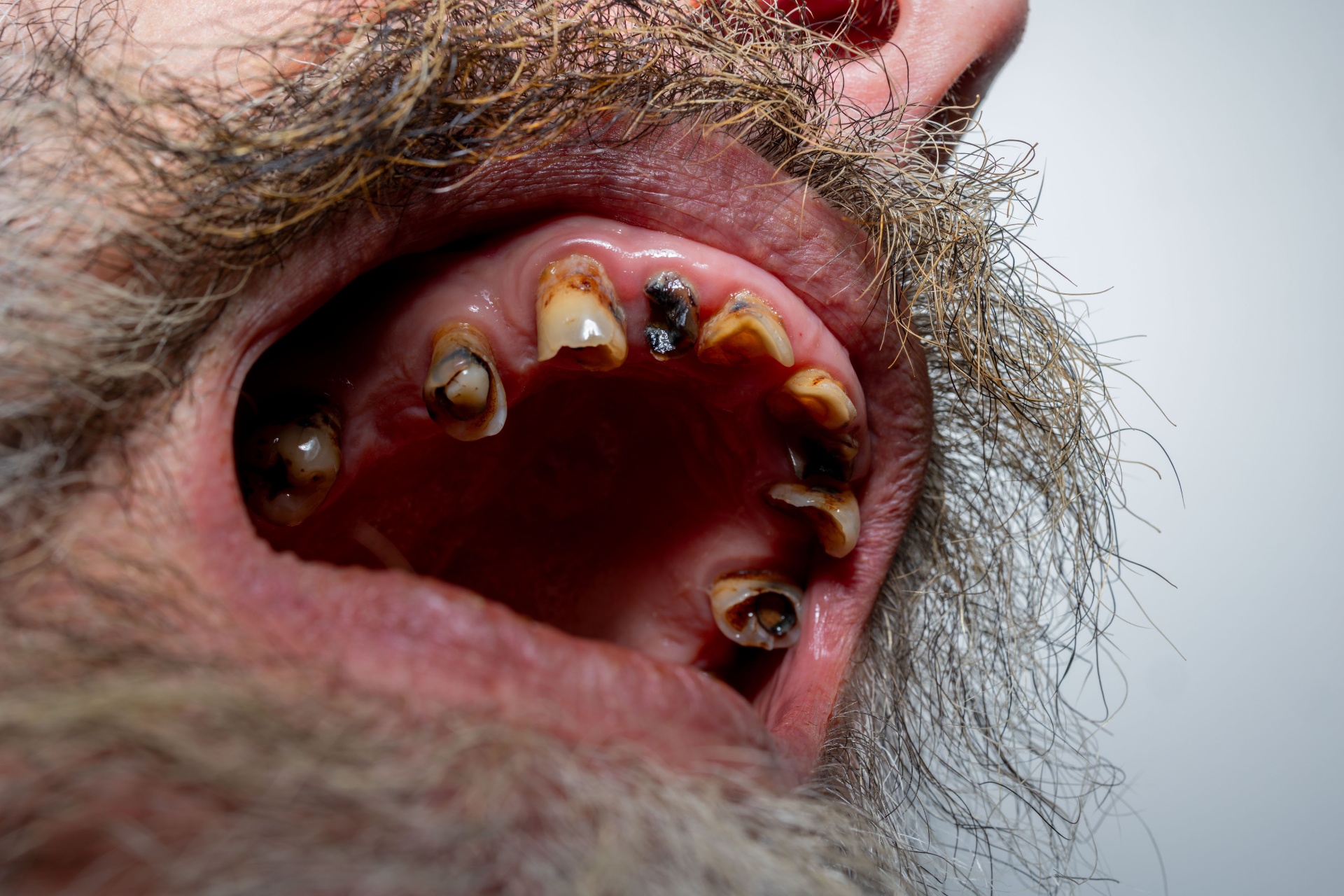 Close-up of a weathered mouth and worn teeth