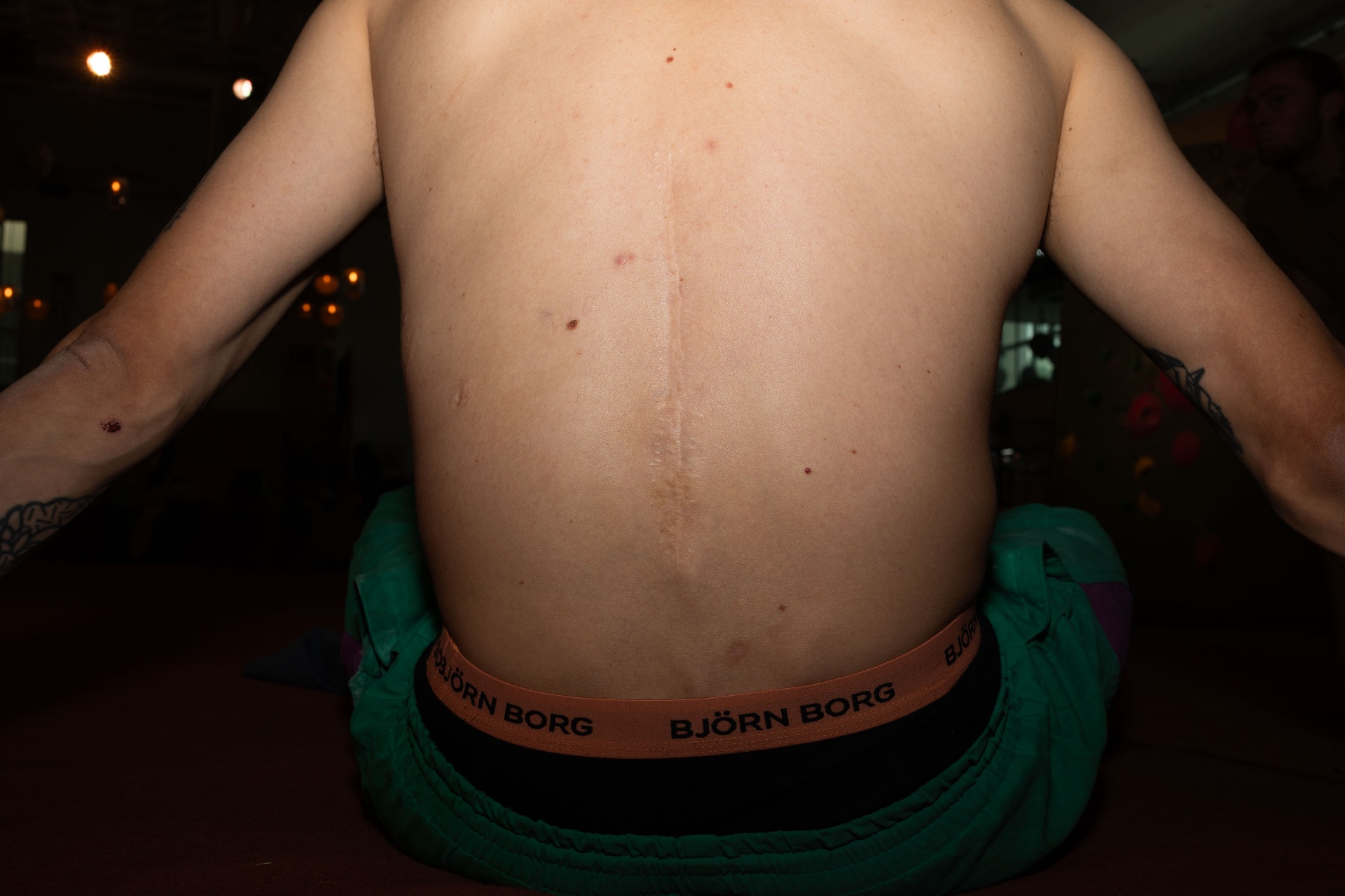 A bare back marked by a long surgical scar